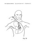 Device, A Kit And A Method For Treatment Of Disorders In The Heart Rhythm     Regulation System diagram and image