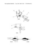 Patella Resection Instrument Guide Having Optional Patient-Specific     Features diagram and image
