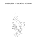 ENDOSCOPIC SUTURE SYSTEMS diagram and image