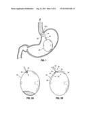 ENDOSCOPIC TOOLS FOR THE REMOVAL OF BALLOON-LIKE INTRAGASTRIC DEVICES diagram and image