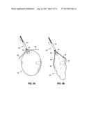 ENDOSCOPIC TOOLS FOR THE REMOVAL OF BALLOON-LIKE INTRAGASTRIC DEVICES diagram and image