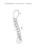 Clavicle Plate and Screws diagram and image