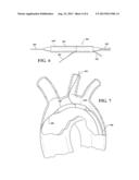 BRANCHED STENT GRAFT DEVICE AND DEPLOYMENT diagram and image