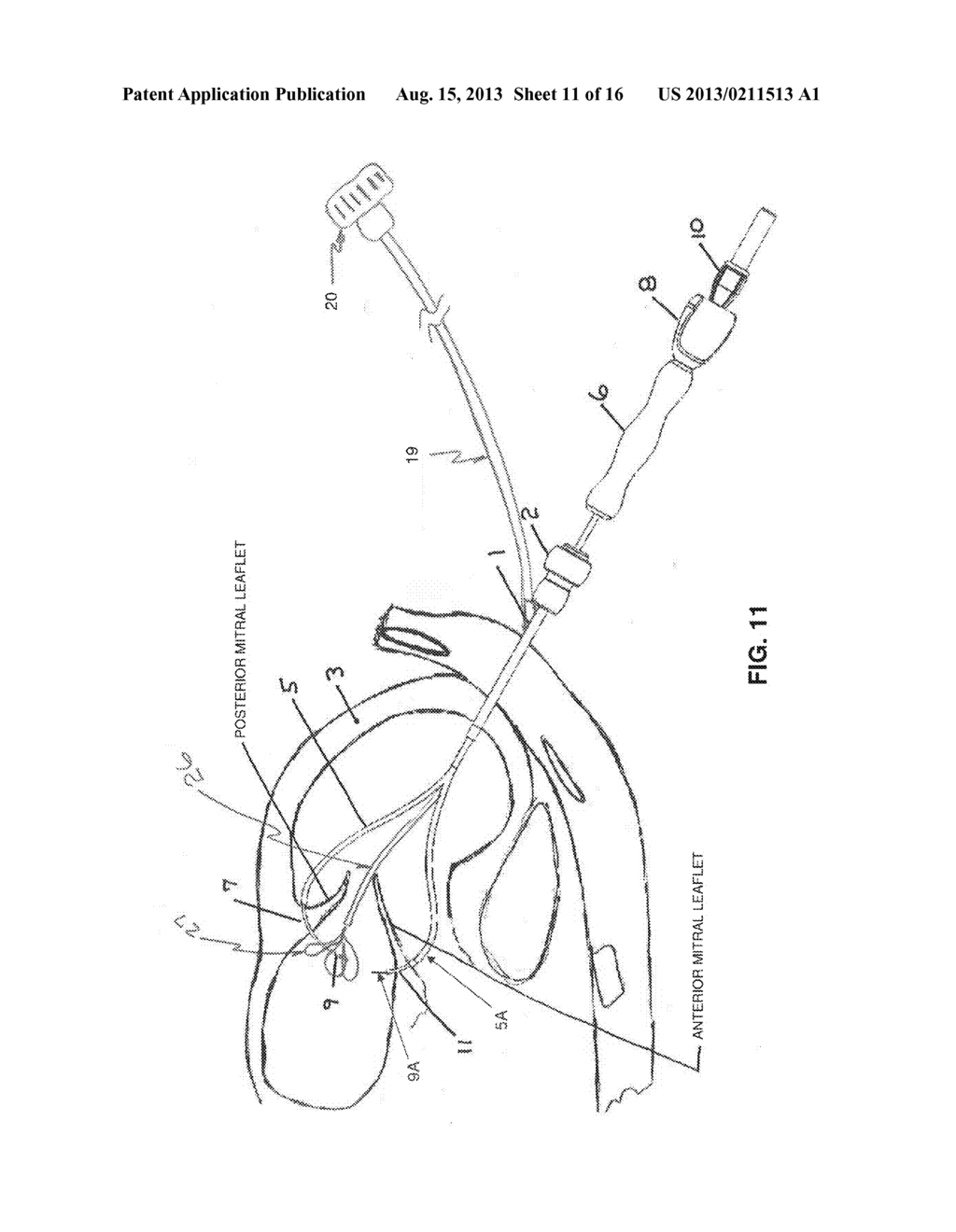 METHOD AND APPARATUS FOR REPAIRING A MITRAL VALVE - diagram, schematic, and image 12