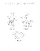 SYSTEMS AND METHODS FOR PROVIDING AN ANTERIOR FLANGE FOR A FEMORAL     COMPONENT diagram and image