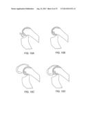 SYSTEMS AND METHODS FOR PROVIDING AN ANTERIOR FLANGE FOR A FEMORAL     COMPONENT diagram and image