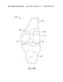 SYSTEMS AND METHODS FOR PROVIDING AN ANTERIOR FLANGE FOR A FEMORAL     COMPONENT diagram and image