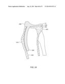 SYSTEMS AND METHODS FOR PROVIDING AN ANTERIOR FLANGE FOR A FEMORAL     COMPONENT diagram and image