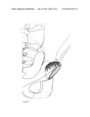 PROSTHESIS diagram and image