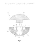 NEGATIVE-POSITIVE PRESSURIZABLE IMPLANT diagram and image