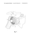 NEGATIVE-POSITIVE PRESSURIZABLE IMPLANT diagram and image