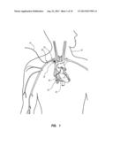 Systems and Methods for Positioning a Catheter diagram and image