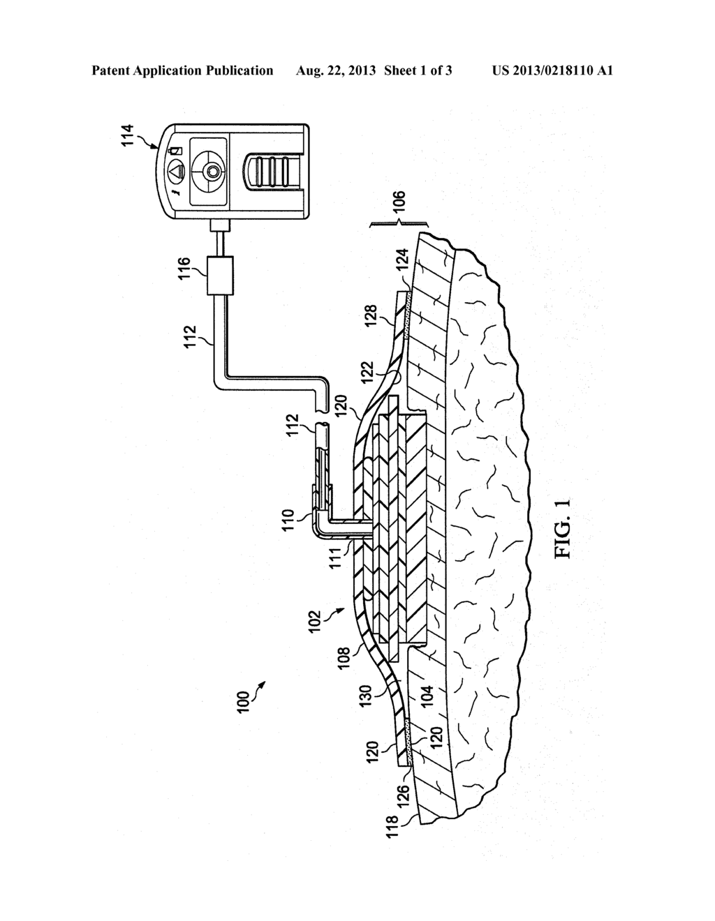 MULTI-LAYER DRESSINGS, SYSTEMS, AND METHODS FOR APPLYING REDUCED PRESSURE     AT A TISSUE SITE - diagram, schematic, and image 02