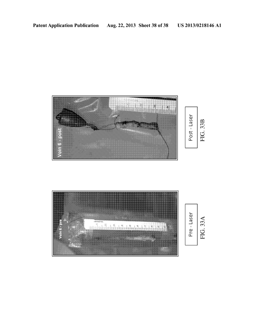 Endovenous Laser Treatment Generating Reduced Blood Coagulation - diagram, schematic, and image 39