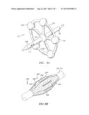 METHOD AND APPARATUS FOR RADICAL PROSTATECTOMY ANASTOMOSIS diagram and image