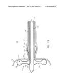 METHOD AND APPARATUS FOR RADICAL PROSTATECTOMY ANASTOMOSIS diagram and image