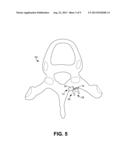 ROD-RECEIVING SPINAL FUSION ATTACHMENT ELEMENTS diagram and image