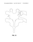 ROD-RECEIVING SPINAL FUSION ATTACHMENT ELEMENTS diagram and image