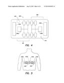 ELECTRODE WITH REDUNDANT IMPEDANCE REDUCTION diagram and image