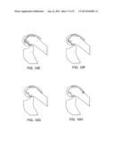 SYSTEMS AND METHODS FOR PROVIDING AN ASYMMETRICAL TIBIAL COMPONENT diagram and image