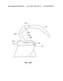 SYSTEMS AND METHODS FOR PROVIDING AN ASYMMETRICAL TIBIAL COMPONENT diagram and image