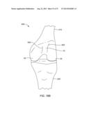 SYSTEMS AND METHODS FOR PROVIDING AN ASYMMETRICAL TIBIAL COMPONENT diagram and image