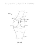 SYSTEMS AND METHODS FOR PROVIDING AN ASYMMETRICAL TIBIAL COMPONENT diagram and image