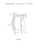 SYSTEMS AND METHODS FOR PROVIDING AN ASYMMETRICAL TIBIAL COMPONENT diagram and image