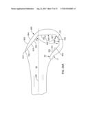 SYSTEMS AND METHODS FOR PROVIDING AN ASYMMETRICAL TIBIAL COMPONENT diagram and image