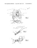 Quick-Connect Outflow Tube for Ventricular Assist Device diagram and image