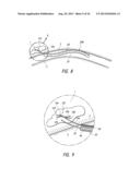 PULMONARY NODULE ACCESS DEVICES AND METHODS OF USING THE SAME diagram and image