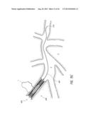 PULMONARY NODULE ACCESS DEVICES AND METHODS OF USING THE SAME diagram and image