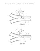 PULMONARY NODULE ACCESS DEVICES AND METHODS OF USING THE SAME diagram and image