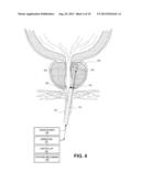 Systems and Methods for Treatment of Prostatic Tissue diagram and image