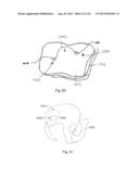 SACROILIAC FUSION SYSTEM diagram and image