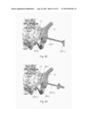 SACROILIAC FUSION SYSTEM diagram and image