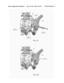 SACROILIAC FUSION SYSTEM diagram and image