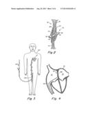 Catch Member for PFO Occluder diagram and image