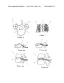 METHOD AND APPARATUS TO PROMOTE INFLAMMATION IN SPINAL TISSUES diagram and image