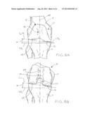 FEMORAL PROSTHESIS WITH MEDIALIZED PATELLAR GROOVE diagram and image