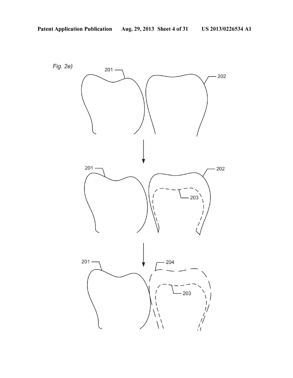 DESIGNING A VIRTUAL PREPARATION AND A VIRTUAL GINGIVAL - diagram, schematic, and image 05