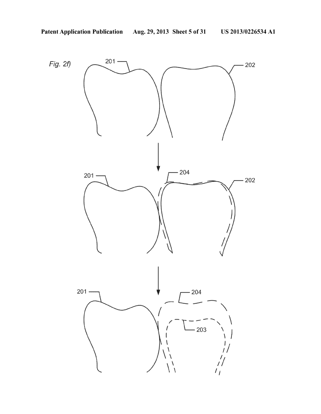 DESIGNING A VIRTUAL PREPARATION AND A VIRTUAL GINGIVAL - diagram, schematic, and image 06