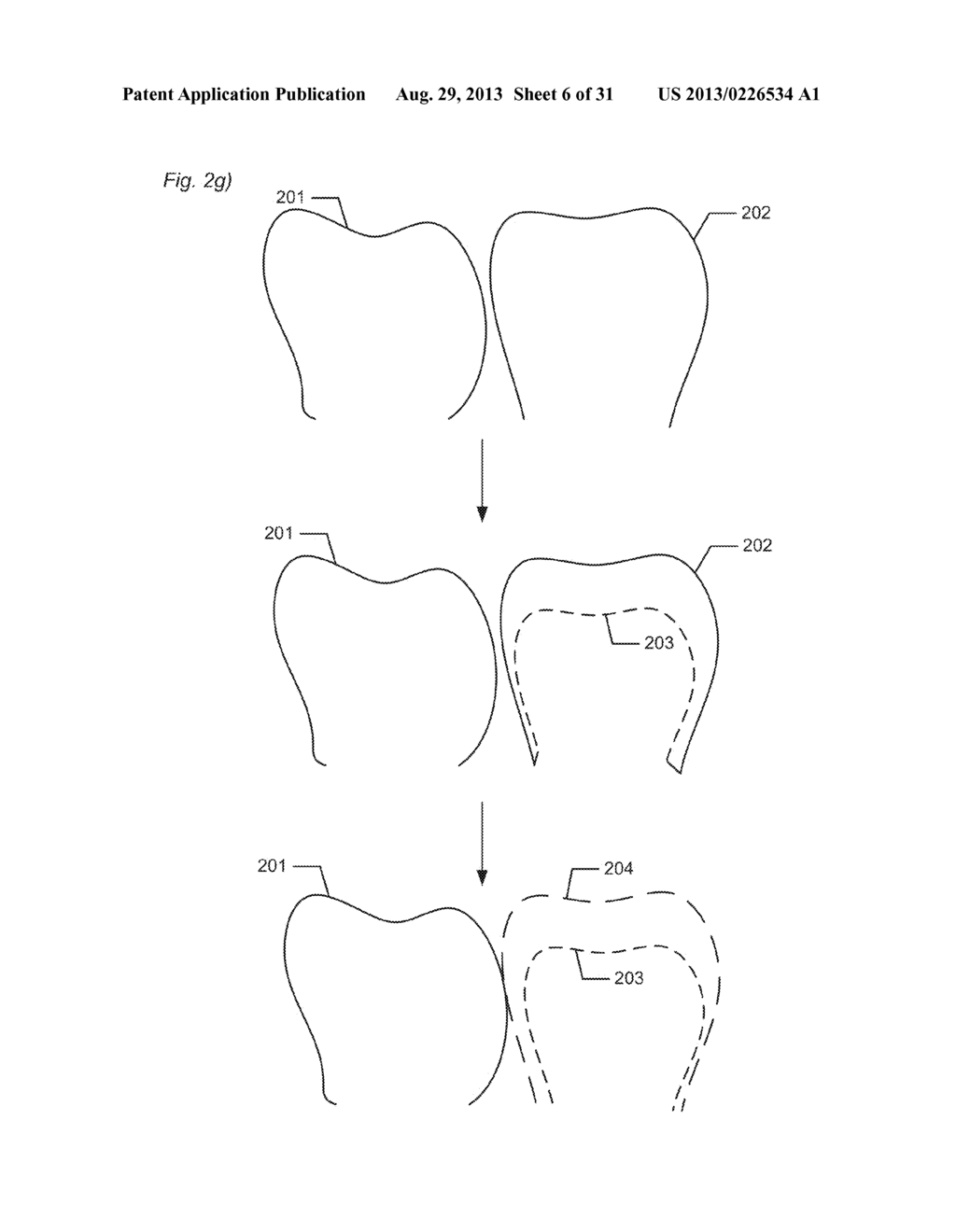 DESIGNING A VIRTUAL PREPARATION AND A VIRTUAL GINGIVAL - diagram, schematic, and image 07