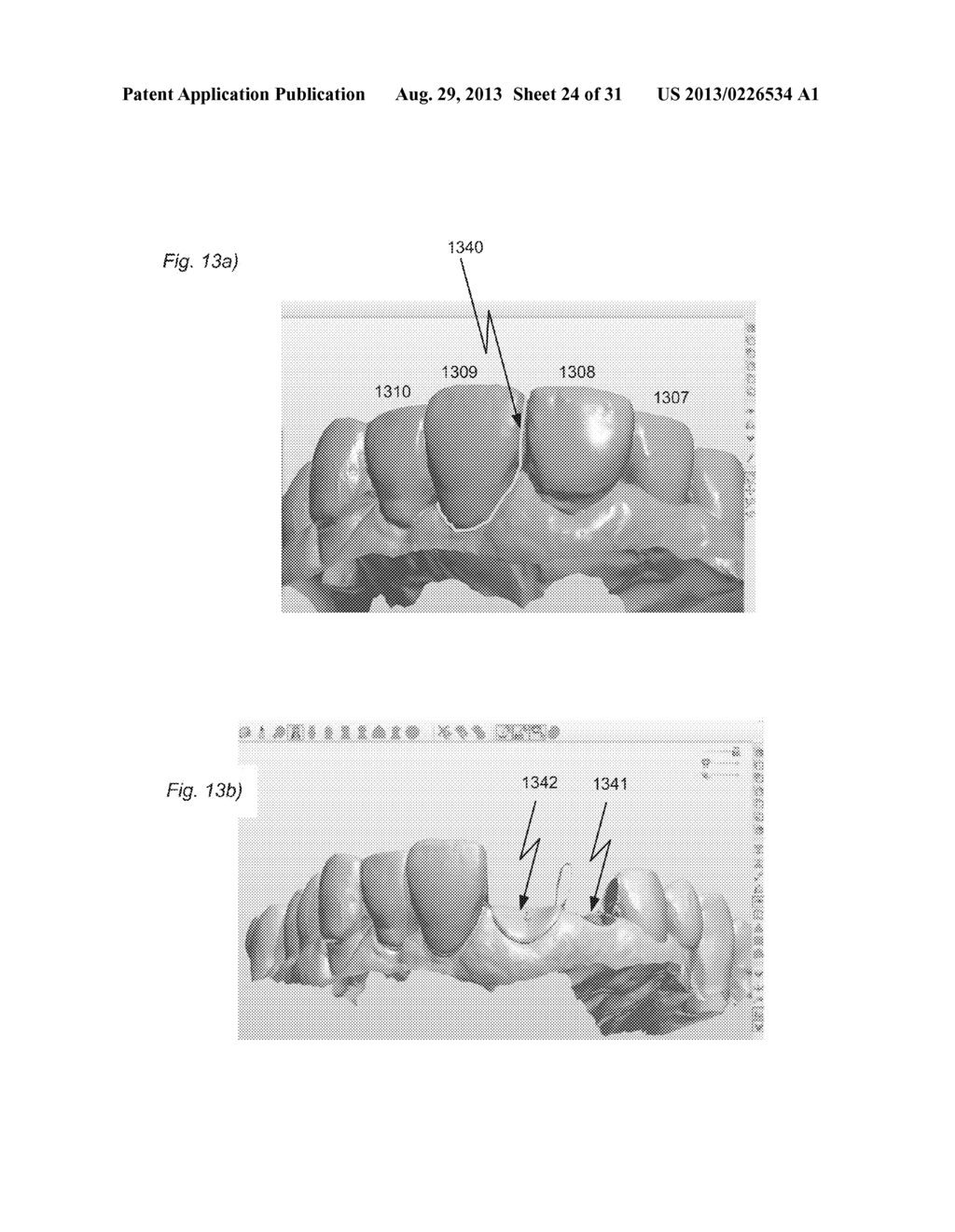 DESIGNING A VIRTUAL PREPARATION AND A VIRTUAL GINGIVAL - diagram, schematic, and image 25