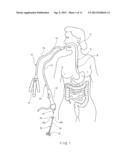 Apparatus and Method for Resectioning Gastro-Esophageal Tissue diagram and image