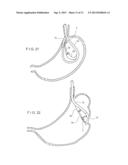 Apparatus and Method for Resectioning Gastro-Esophageal Tissue diagram and image