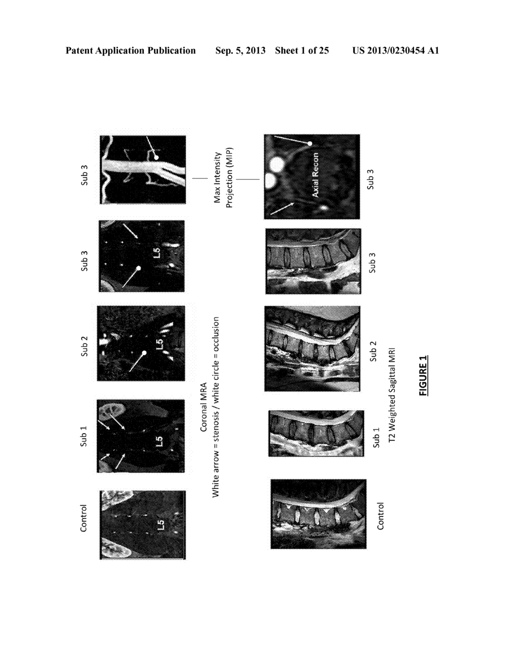 Therapeutic Angiogenesis for Treatment of the Spine and Other Tissues - diagram, schematic, and image 02