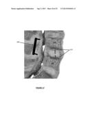 Therapeutic Angiogenesis for Treatment of the Spine and Other Tissues diagram and image