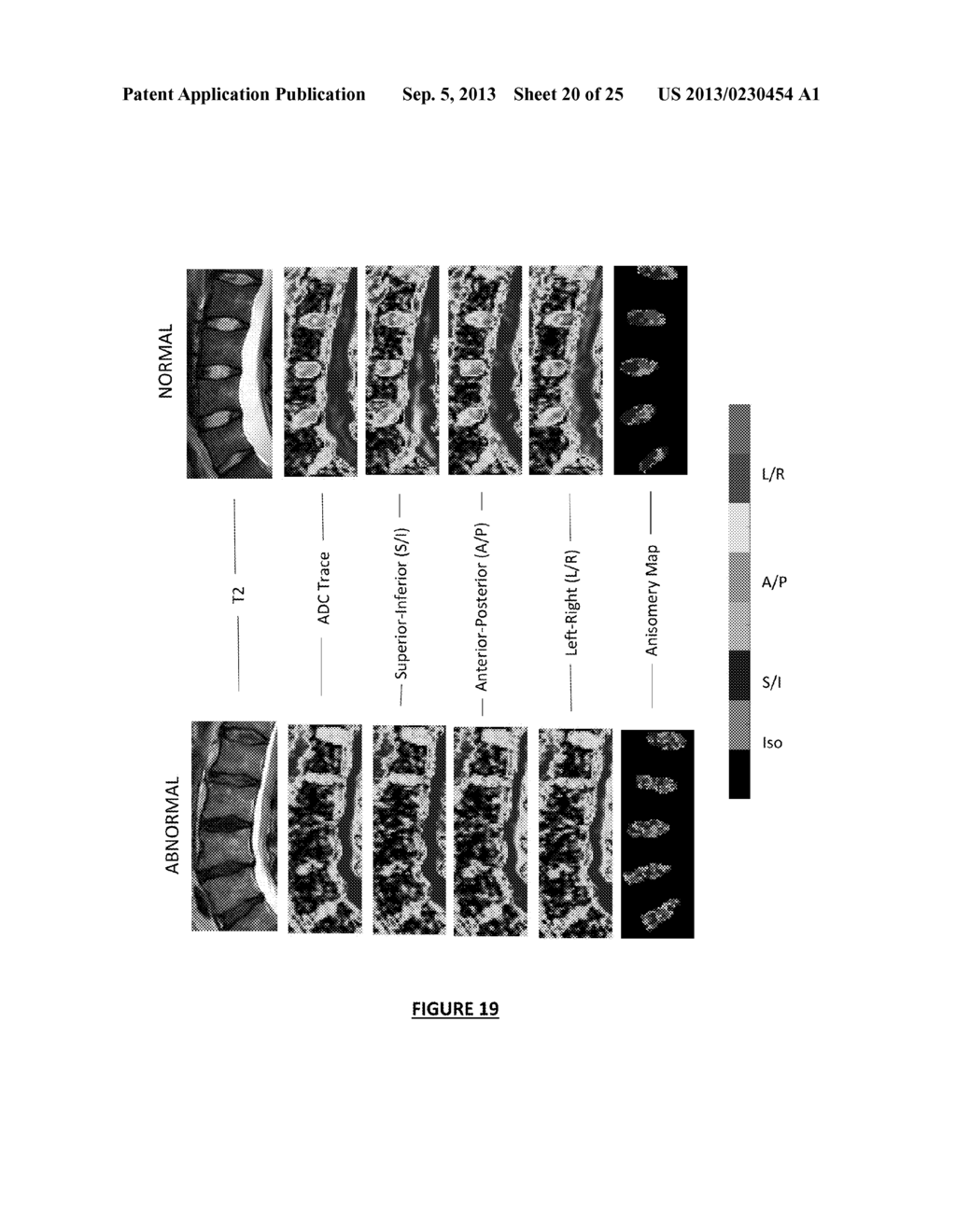 Therapeutic Angiogenesis for Treatment of the Spine and Other Tissues - diagram, schematic, and image 21