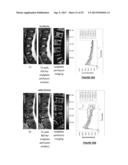 Therapeutic Angiogenesis for Treatment of the Spine and Other Tissues diagram and image
